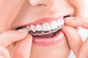 ortodoncia-invisible-alineador-invisalign