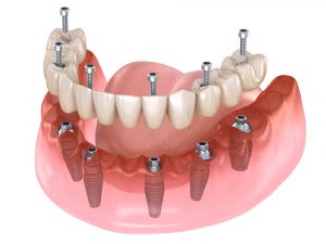 Protesis fija implantes