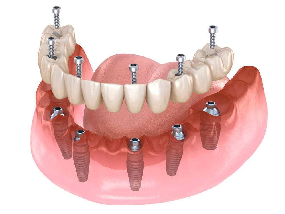 Protesis fija implantes